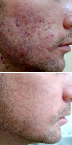 Roaccutane Gel Acheter Ligne