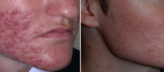 Où acheter roaccutane