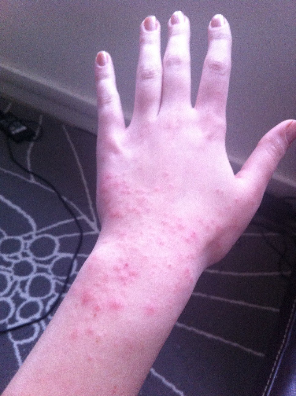 Roaccutane ou pilule