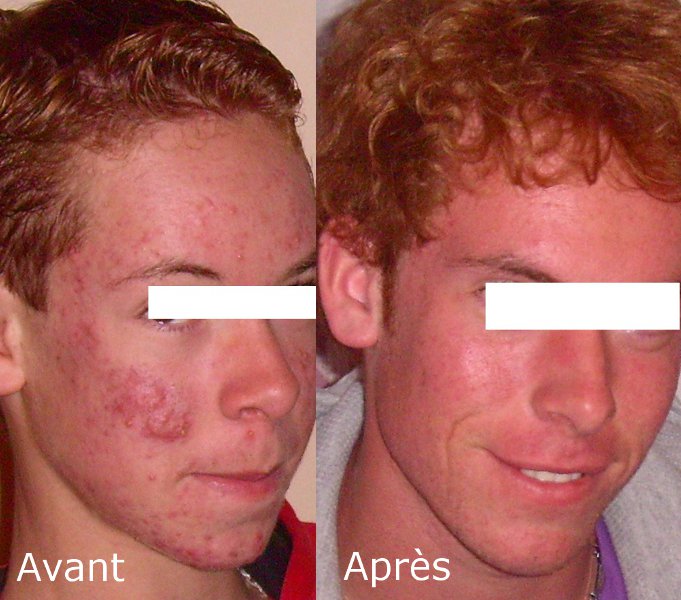 Roaccutane avec pilule