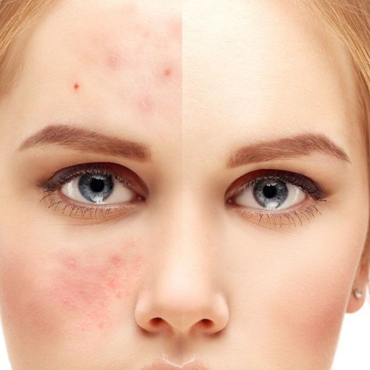 roaccutane avec pilule