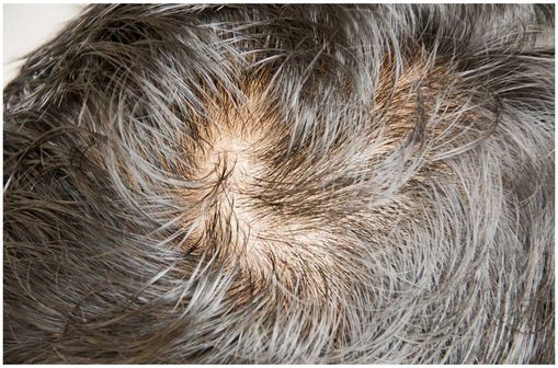 Finasteride 1mg achat