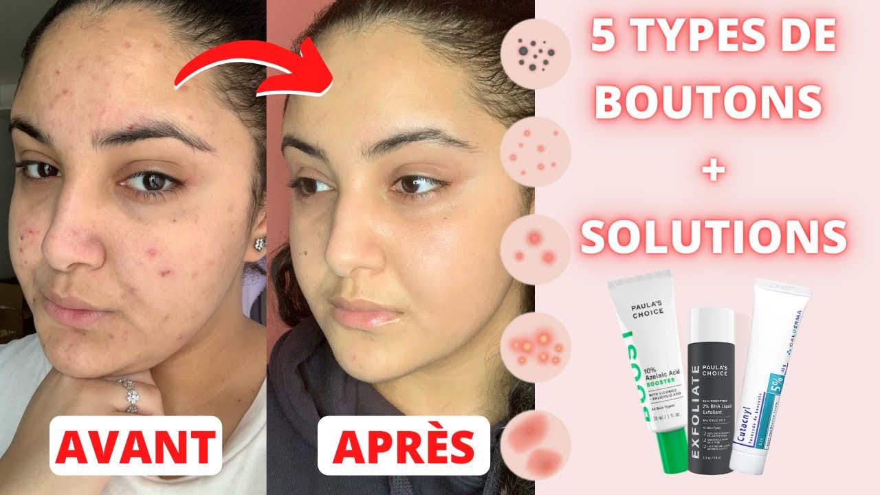 Prix Roaccutane Belgique