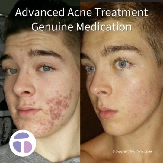 Ordre roaccutane