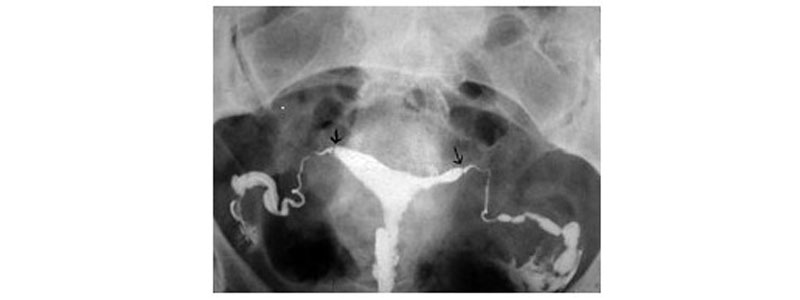 Peut on acheter clomid sans ordonnance