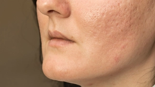 roaccutane gel generique