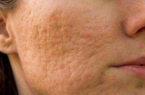 Roaccutane Quelle Pilule