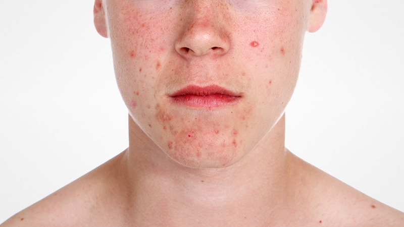 Ordre accutane