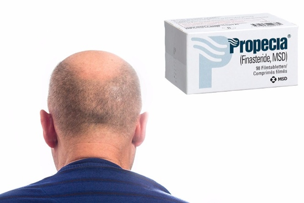 finasteride gel acheter