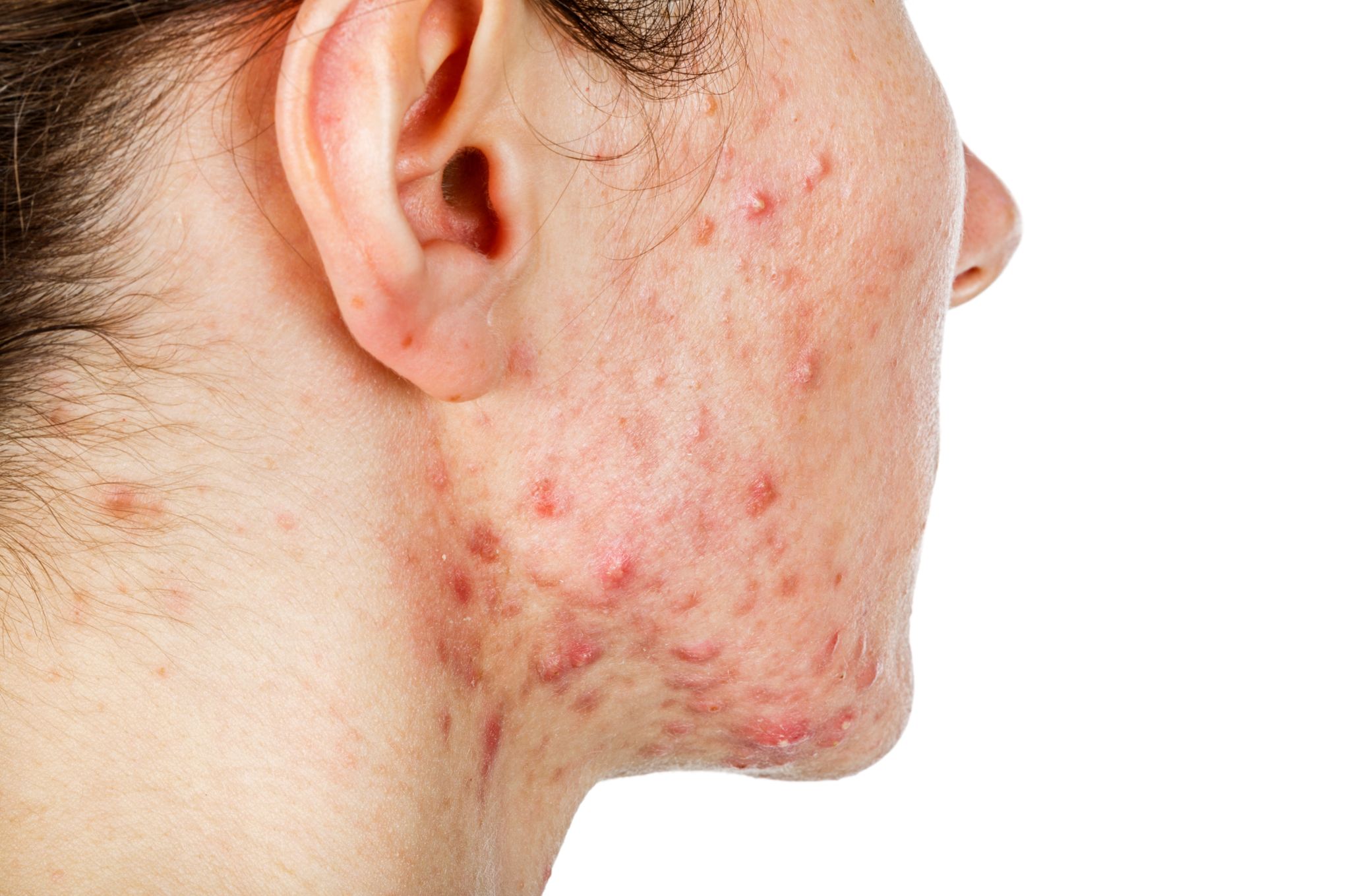 Ordre Roaccutane