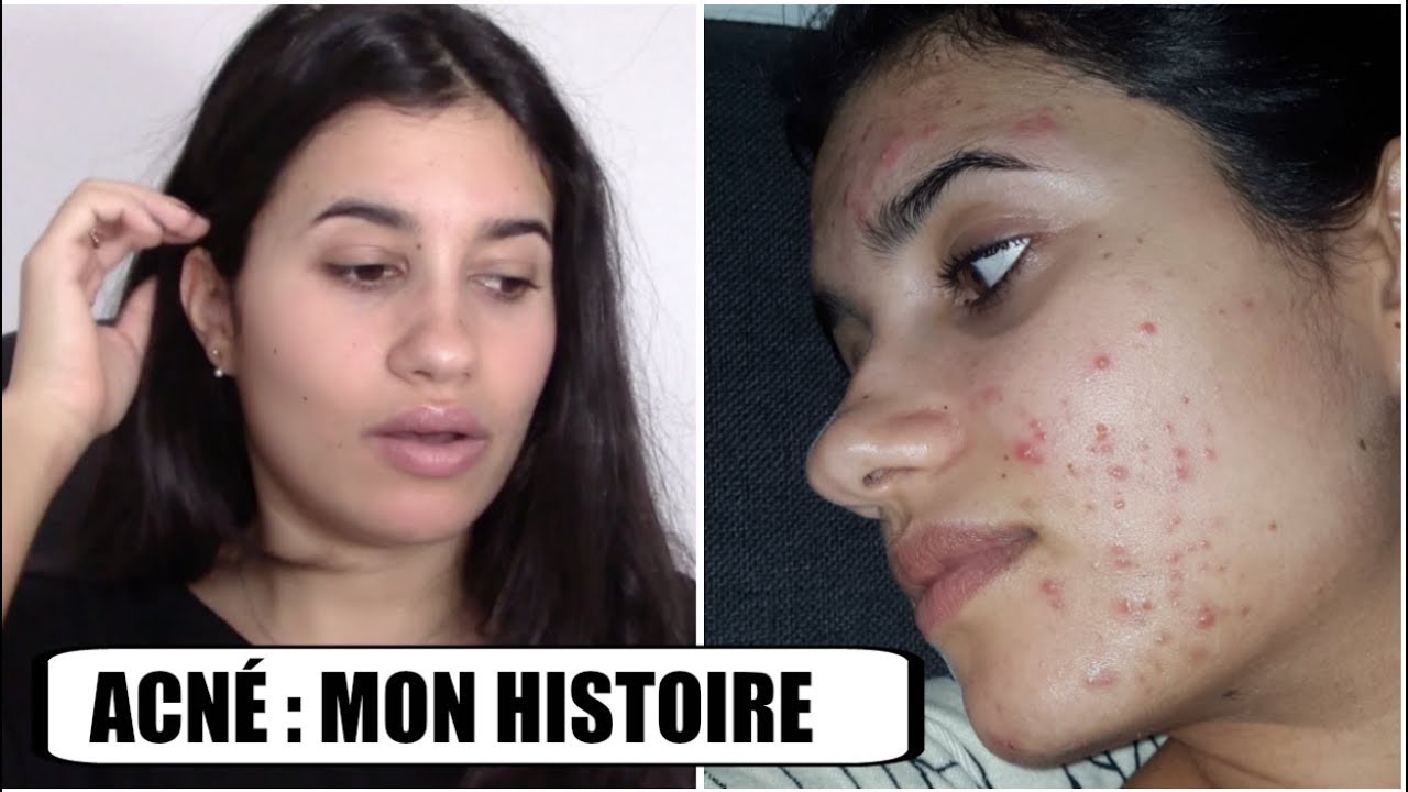 Roaccutane quelle pilule