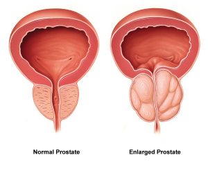 Finasteride acheter sans ordonnance