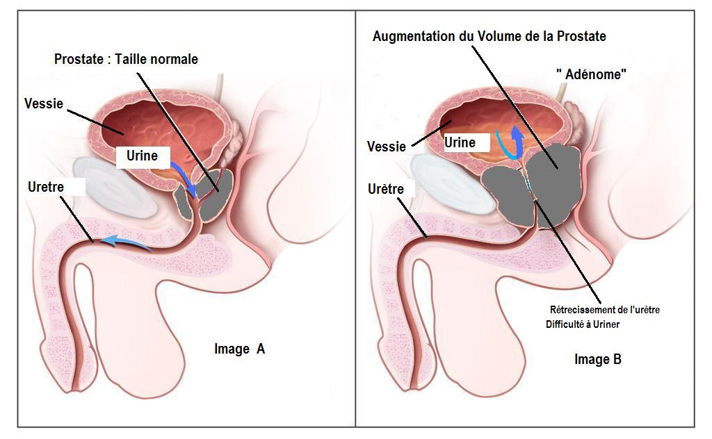 Chibro proscar sans ordonnance