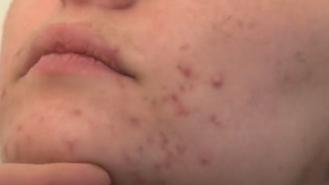 Pilule Sous Roaccutane