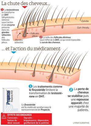 Finasteride Bailleul Prix