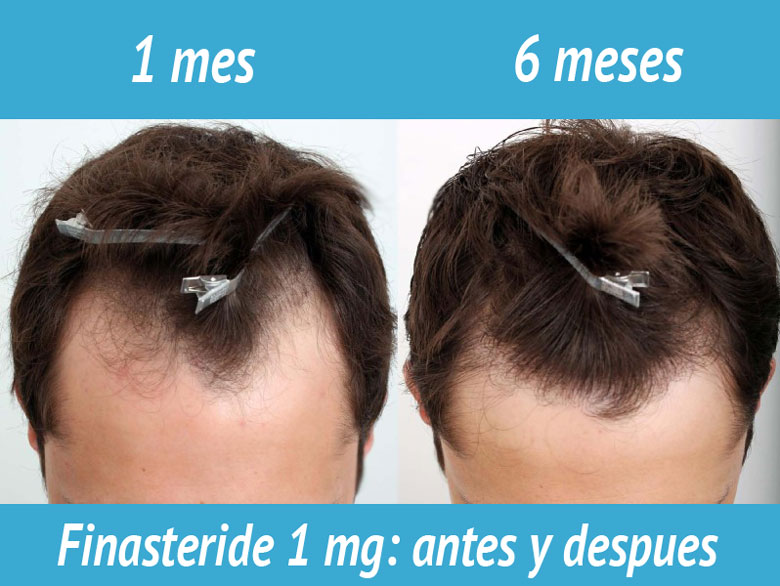 Finasteride Compra Online