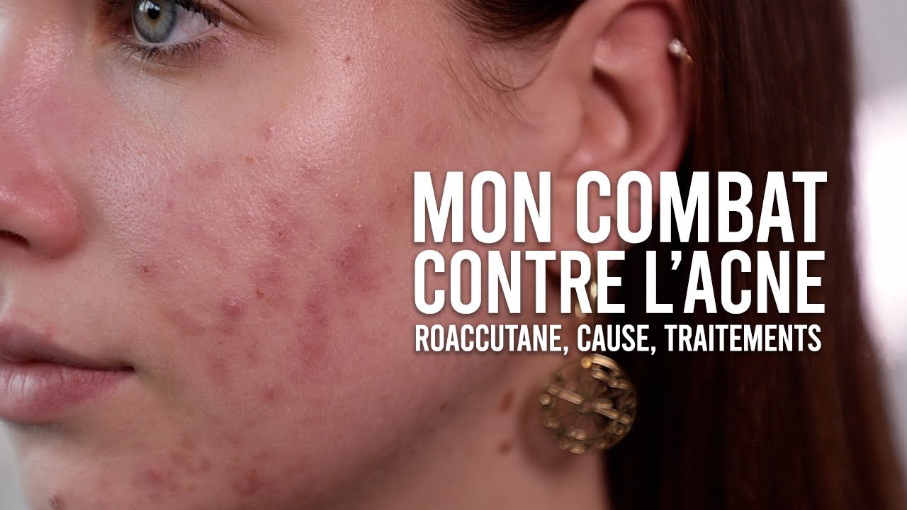 Roaccutane quelle pilule